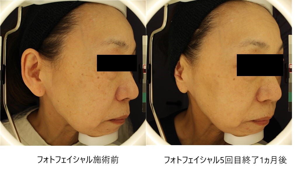 シミ | 金沢のシミ取り・消し治療は、とりい皮膚科クリニック 金沢院